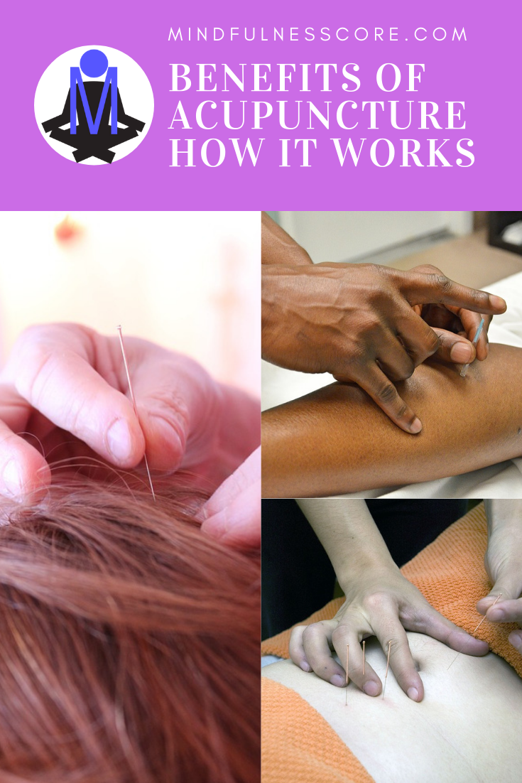 benefits of acupuncture how it works